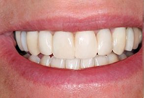 Blackwood Family Dentistry | Cosmetic Dentistry, Dental Bridges and Veneers